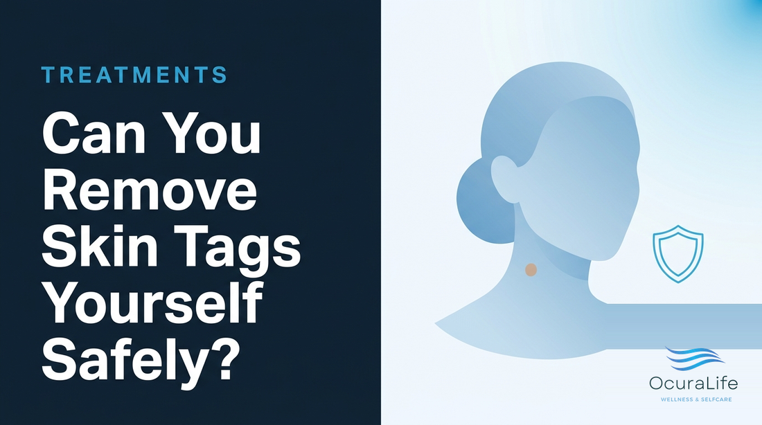 Can You Remove Skin Tags Yourself Safely?