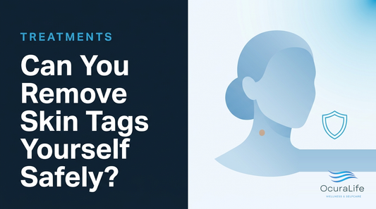 Can You Remove Skin Tags Yourself Safely?