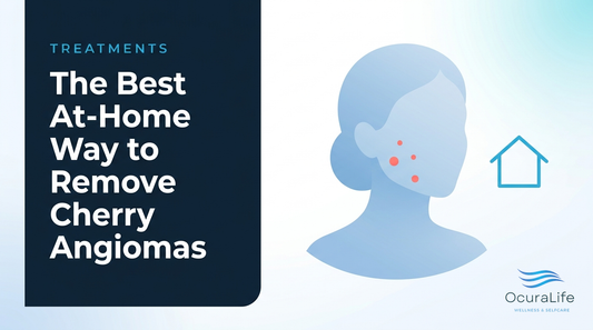 The Best At-Home Way to Remove Cherry Angiomas