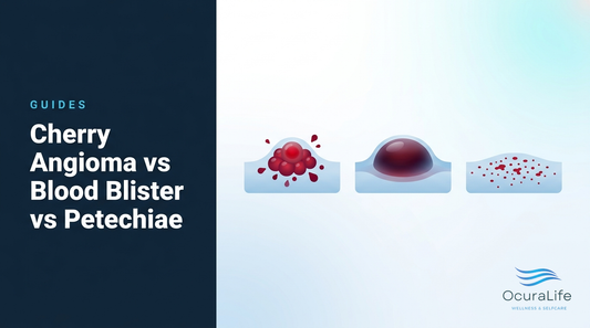 Cherry Angioma vs Blood Blister vs Petechiae