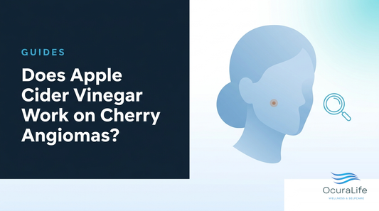 Does Apple Cider Vinegar Work on Cherry Angiomas?