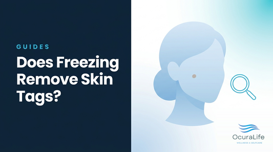 Does Freezing Remove Skin Tags?