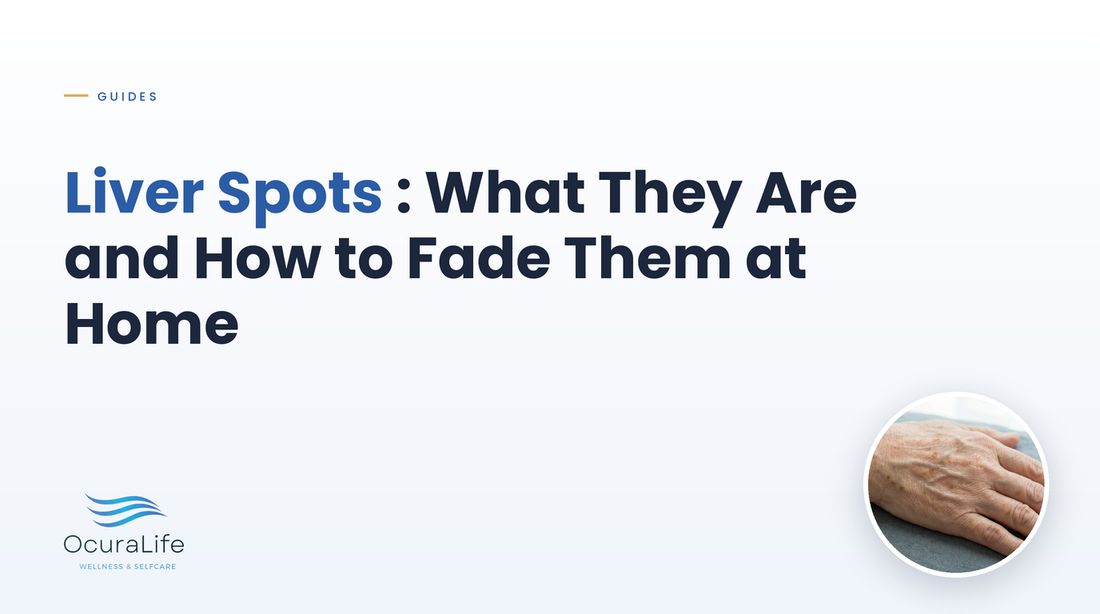 Liver Spots: What They Are and How to Fade Them at Home