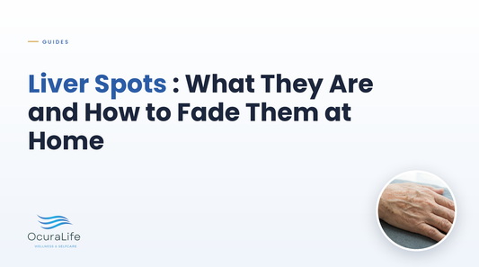 Liver Spots: What They Are and How to Fade Them at Home