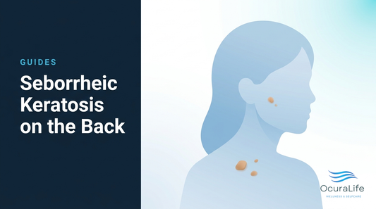 Editorial illustration: Seborrheic Keratosis on the Back