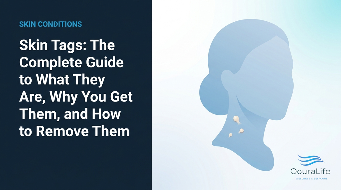 Skin Tags: The Complete Guide to What They Are, Why You Get Them, and How to Remove Them