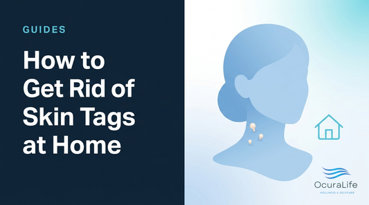 How to Get Rid of Skin Tags at Home