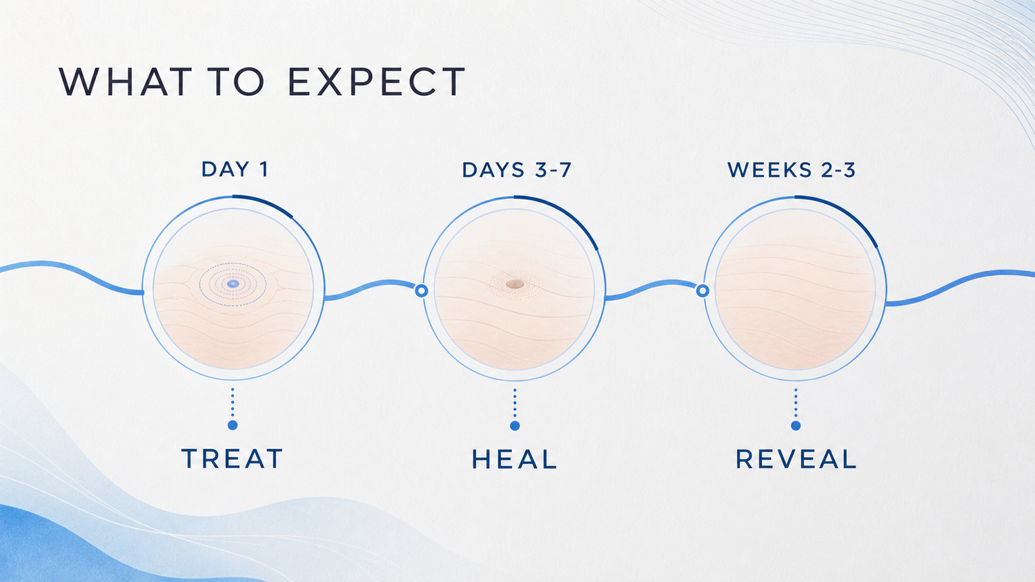 Plasma pen timeline infographic from Day 1 through Days 3 to 7 and Weeks 2 to 3