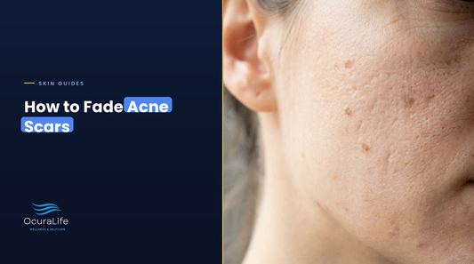 Close-up of a cheek with shallow acne scars and flat brown acne marks