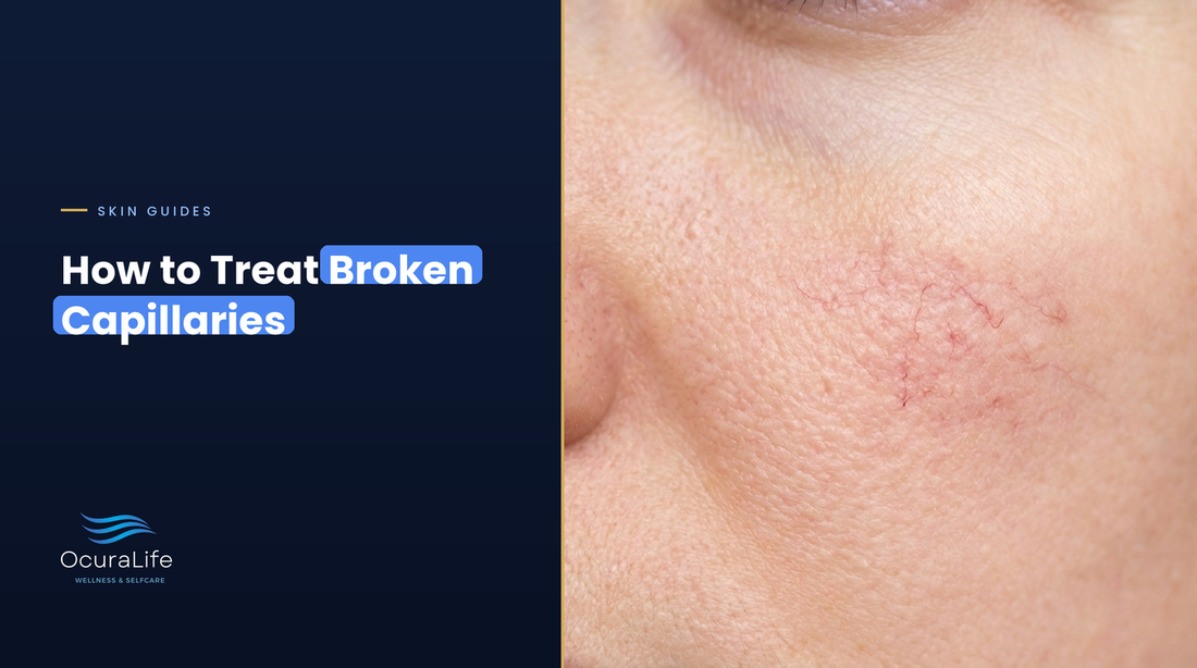 Fine red broken capillaries on the cheek beside the nose