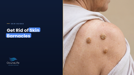 Skin barnacles (seborrheic keratoses) on a woman's shoulder and upper back