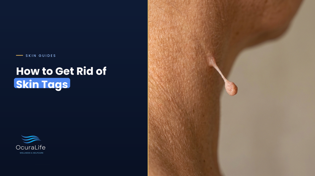 How to get rid of skin tags: a soft skin tag on a narrow stalk on the neck