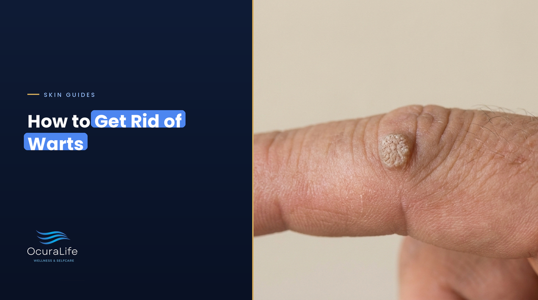 How to get rid of warts: a common wart on a finger