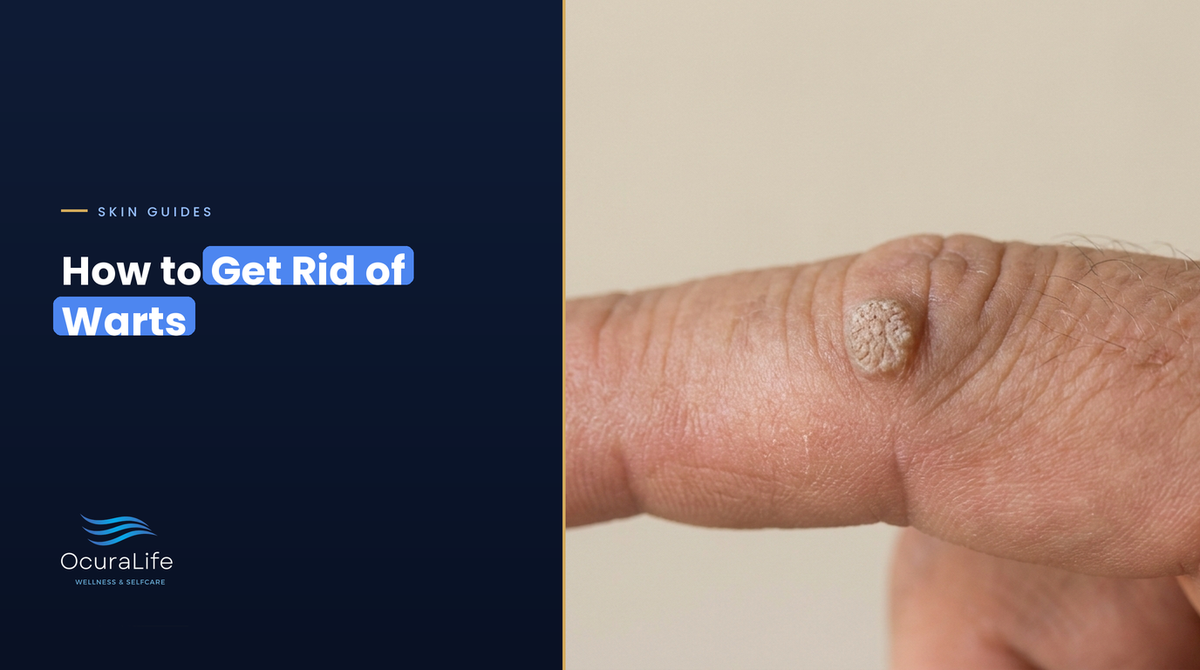 How to get rid of warts: a common wart on a finger