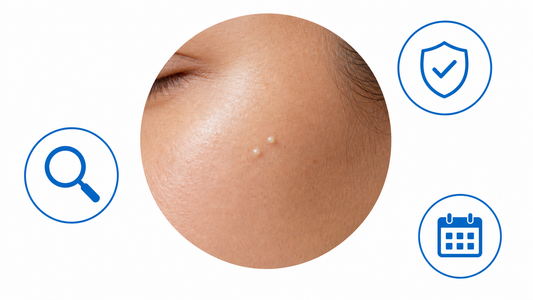How to Remove Milia at Home Safely, Method by Method infographic