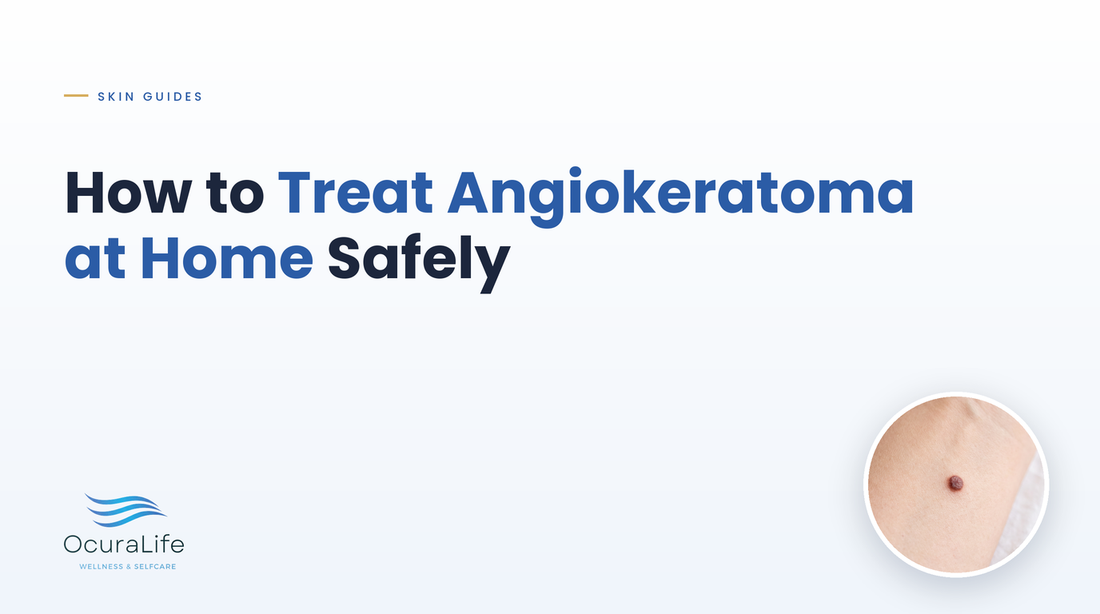 How to Treat Angiokeratoma at Home Safely