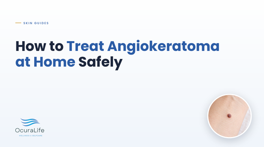 How to Treat Angiokeratoma at Home Safely