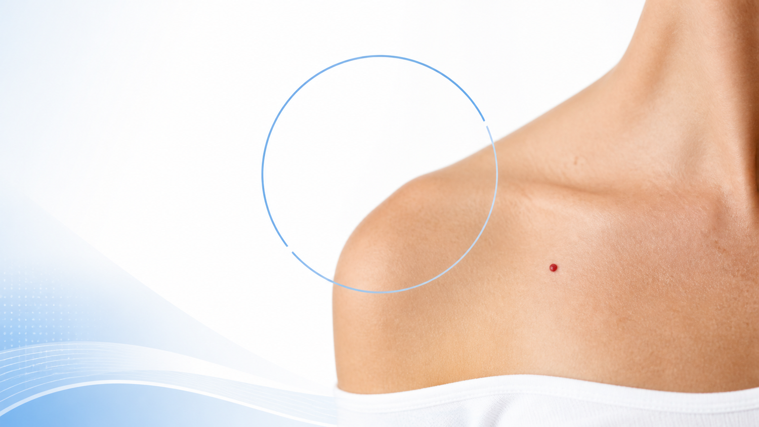 Is It Safe to Remove Cherry Angiomas at Home? infographic