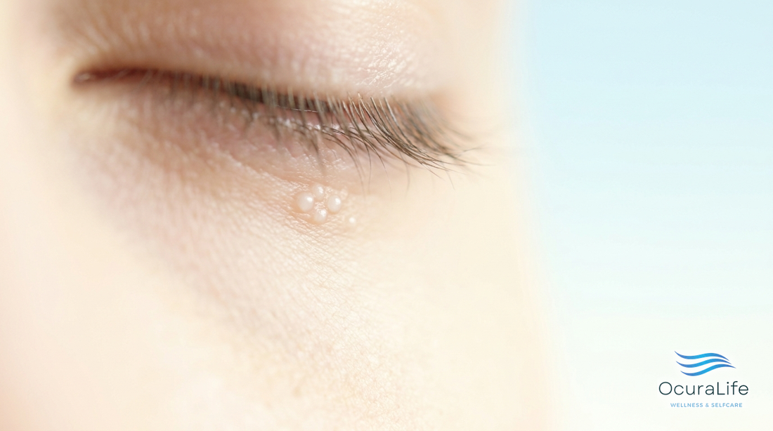 Milia on the Lower Lash Line vs Clogged Oil Glands