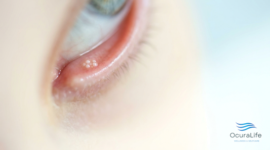 Milia on the Waterline: Why They Form on the Eye Margin