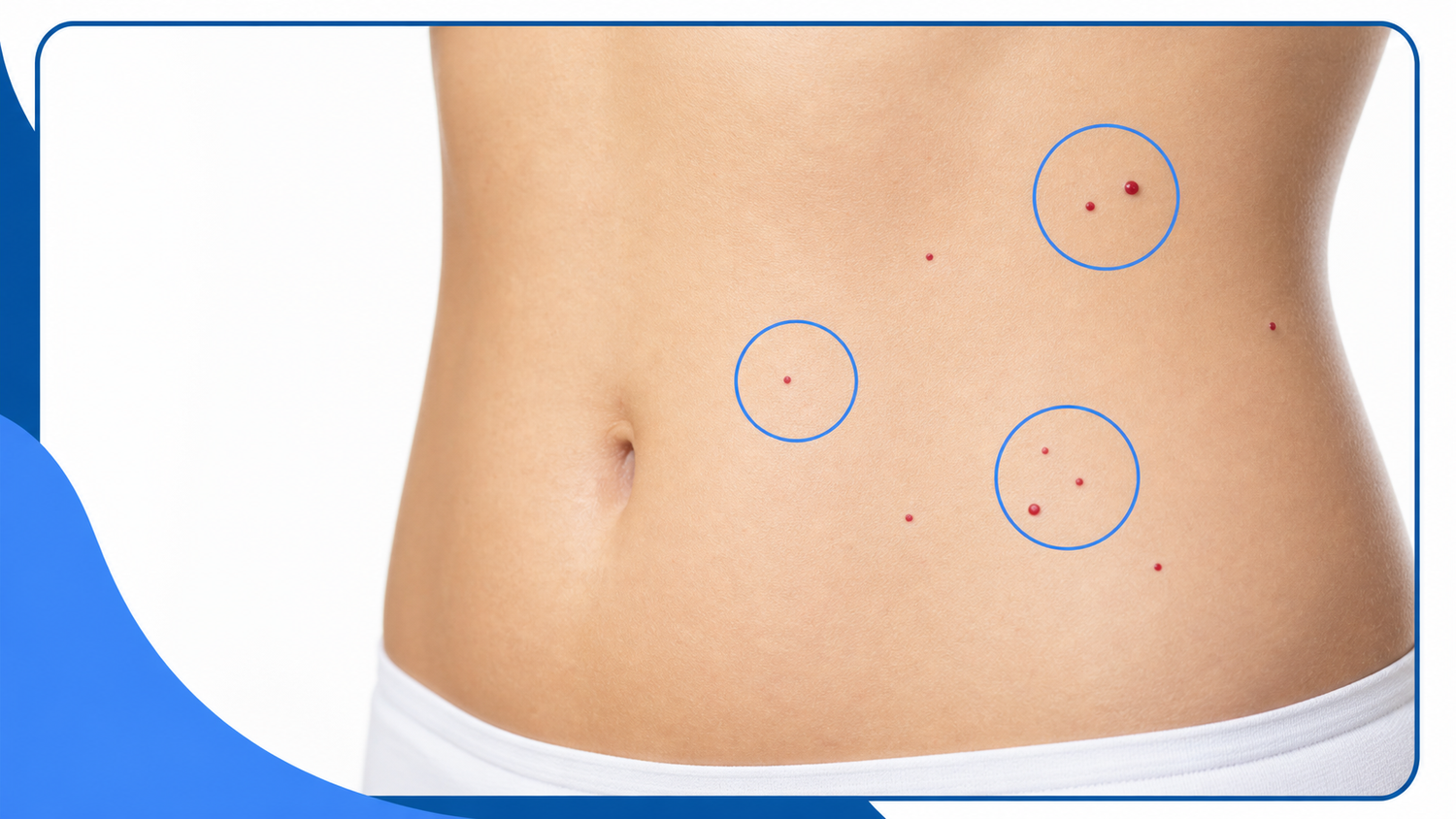 Why You Suddenly Have Multiple Cherry Angiomas on Your Stomach infographic