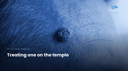The Best At-Home Way to Treat Seborrheic Keratosis on the Temple