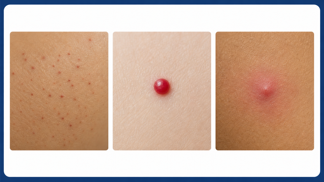 Petechiae vs Cherry Angioma vs Bug Bite: A Visual Guide infographic