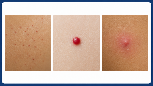 Petechiae vs Cherry Angioma vs Bug Bite: A Visual Guide infographic