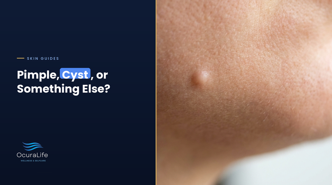 Is It a Pimple, a Cyst, or Something Else?