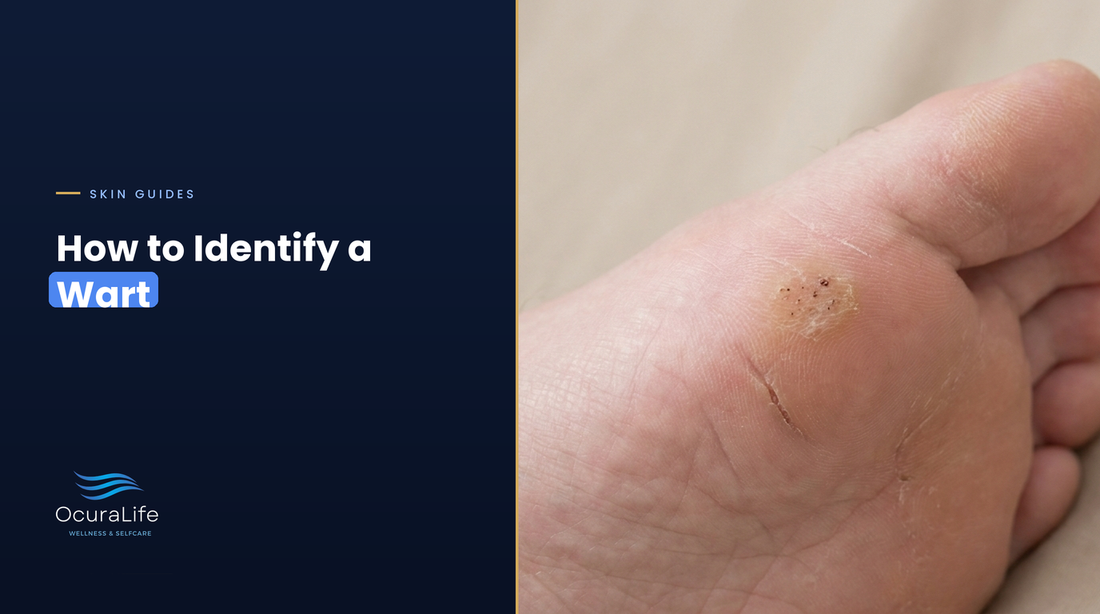 How to identify a wart: plantar wart with black dots on the ball of the foot