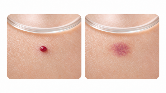 Red Mole vs Blood Spot: How to Tell the Difference infographic
