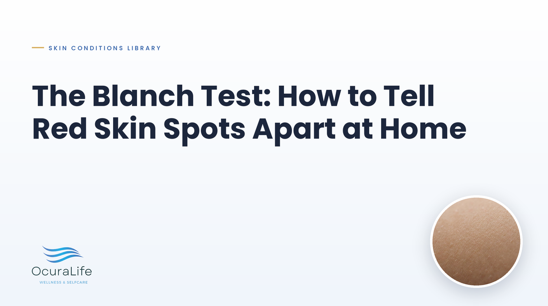 The Blanch Test: How to Tell Red Skin Spots Apart at Home