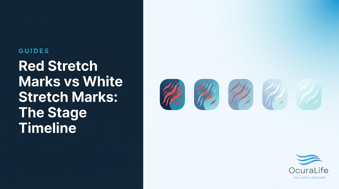 Editorial illustration: Red Stretch Marks vs White Stretch Marks: The Stage Timeline