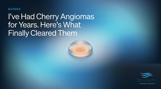 I've Had Cherry Angiomas for Years. Here's What Finally Cleared Them