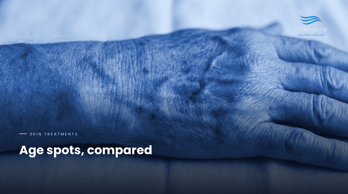Age spots compared: plasma pen, hydroquinone, laser