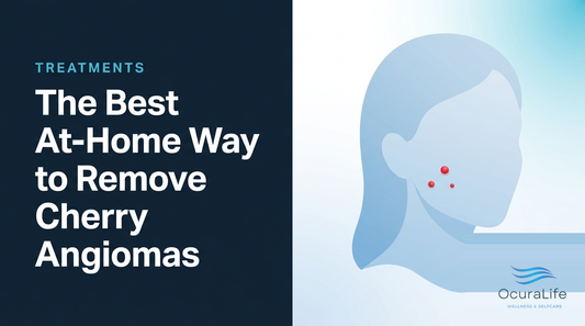 The Best At-Home Way to Remove Cherry Angiomas