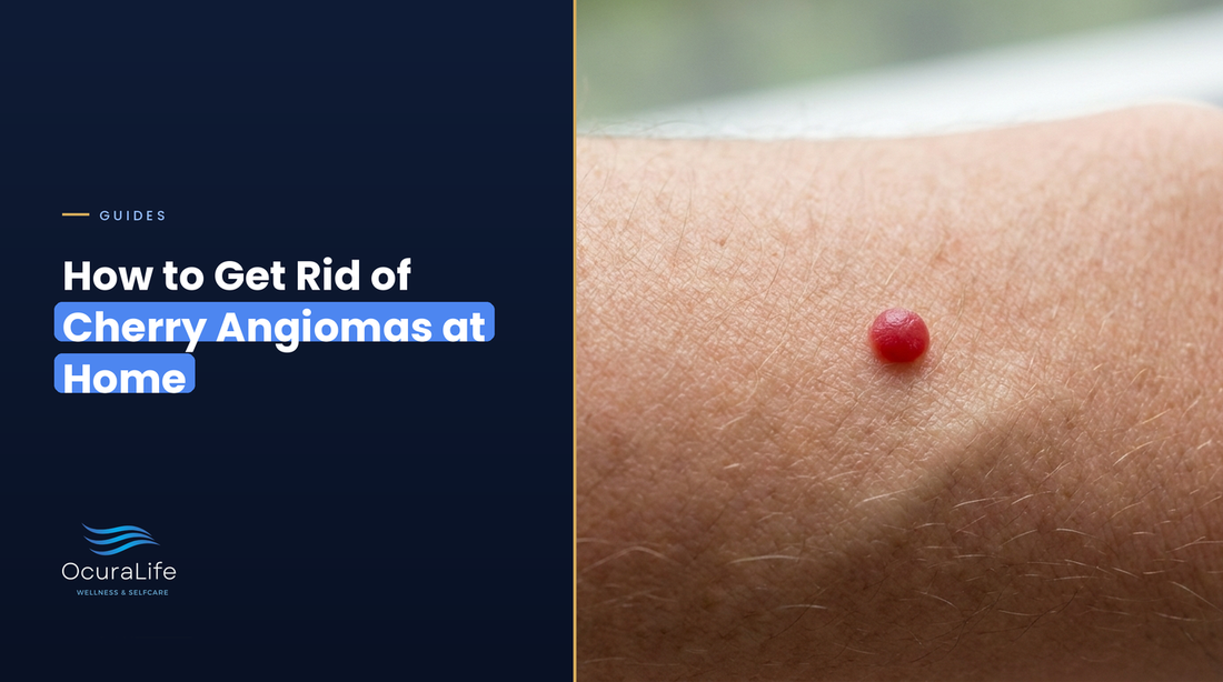 How to Get Rid of Cherry Angiomas at Home