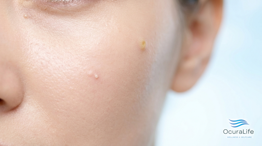 Milia vs Whiteheads vs Sebaceous Hyperplasia: How to Tell Them Apart