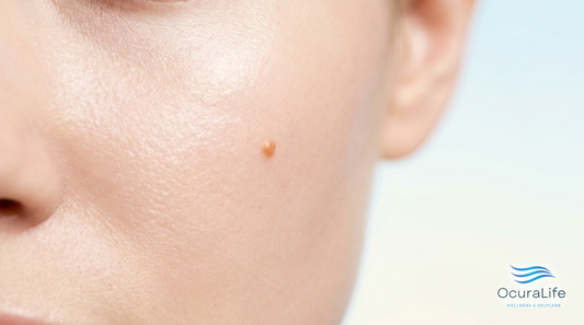 Best Plasma Pen for Seborrheic Keratosis