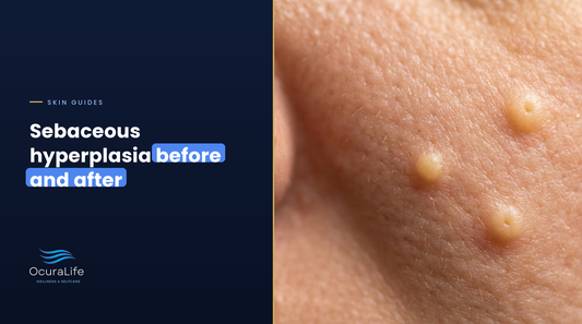 Sebaceous Hyperplasia Removal: Before and After