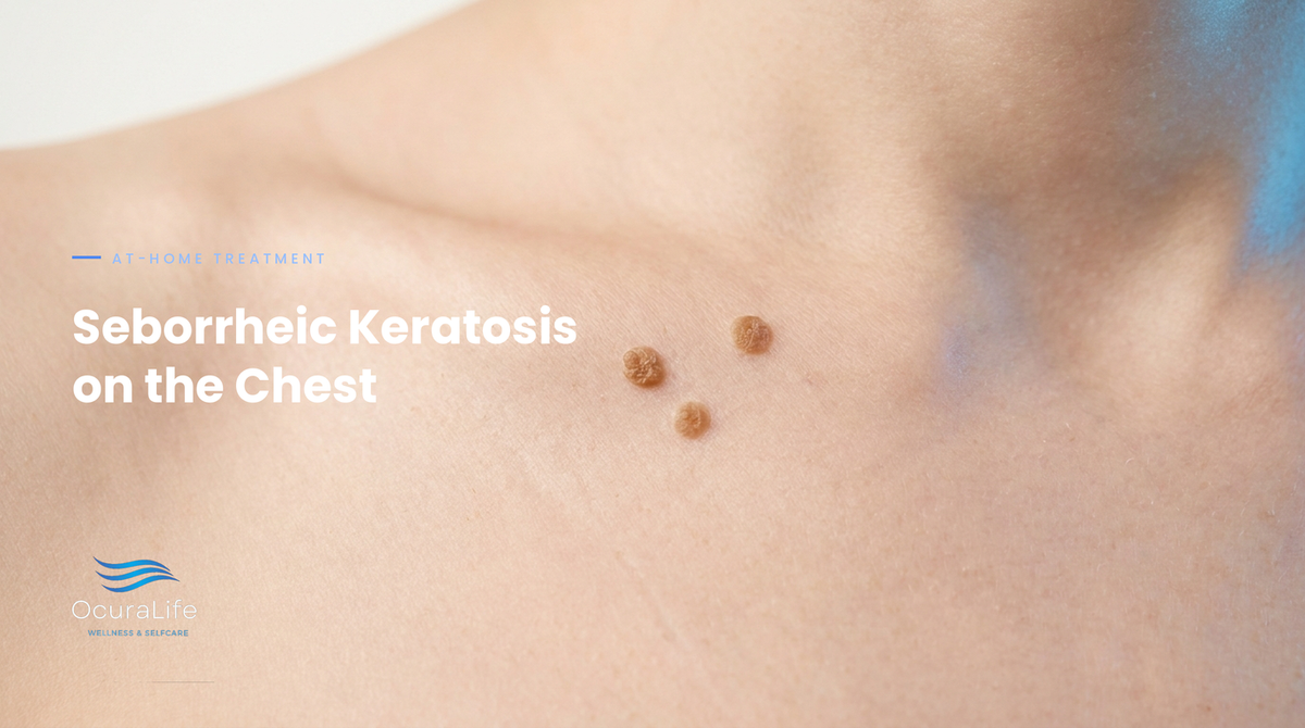 The Best At-Home Way to Treat Seborrheic Keratosis on the Chest