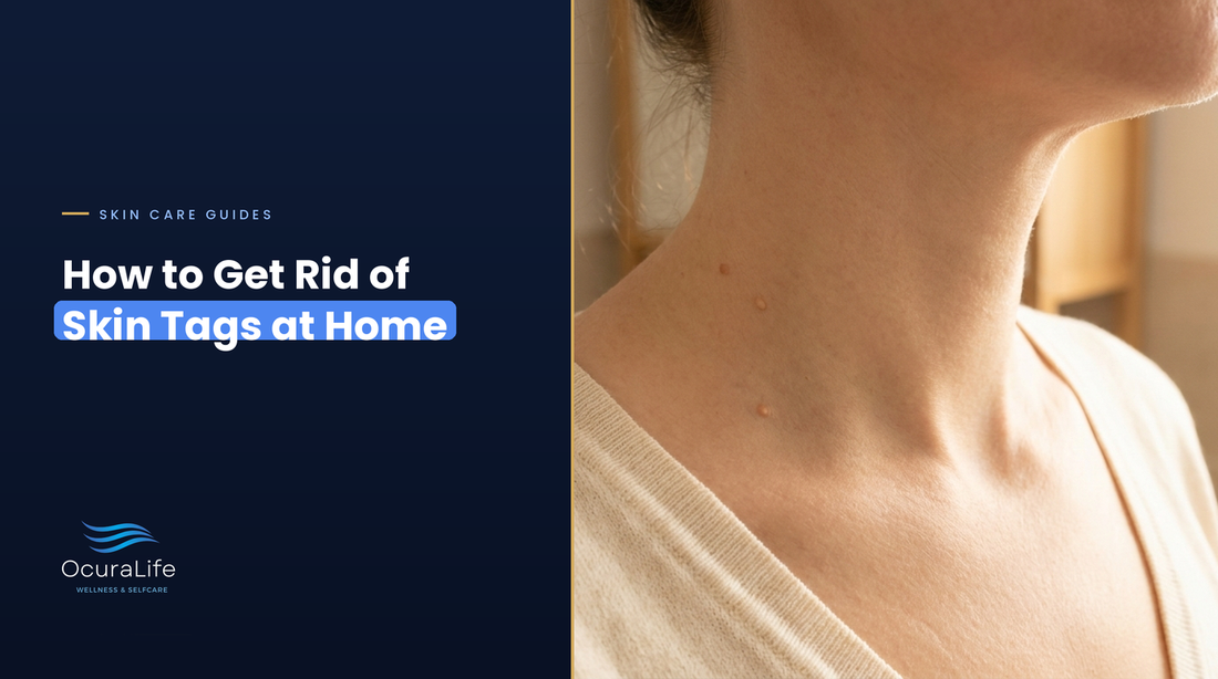 How to Get Rid of Skin Tags at Home