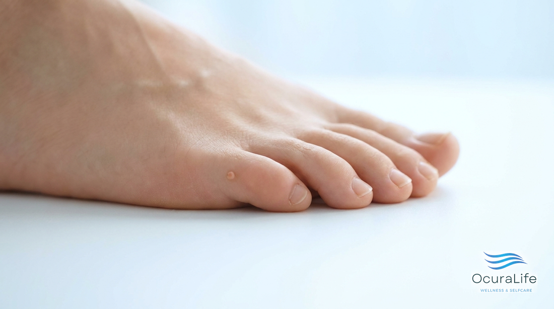 A small benign skin tag on the skin of a healthy foot near the toes