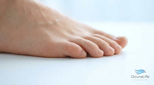 A small benign skin tag on the skin of a healthy foot near the toes