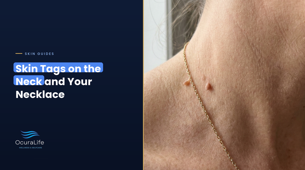 Skin tags on the side of the neck next to a thin necklace chain