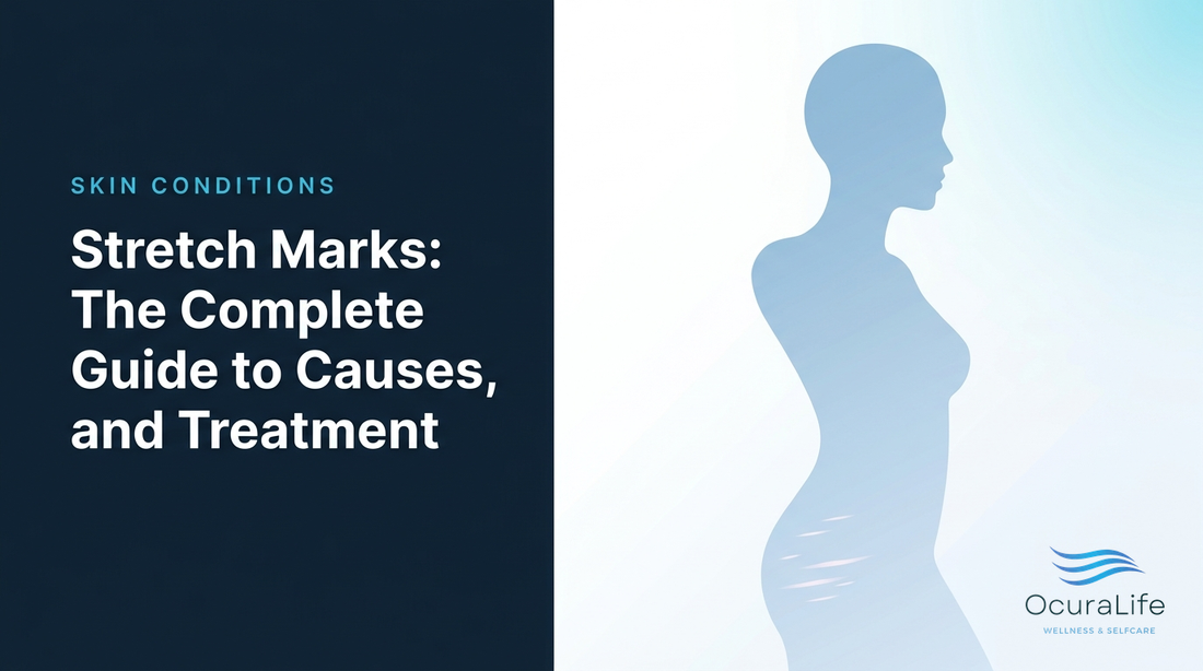 Editorial illustration: Stretch Marks: The Complete Guide to Causes, Types, and Treatment