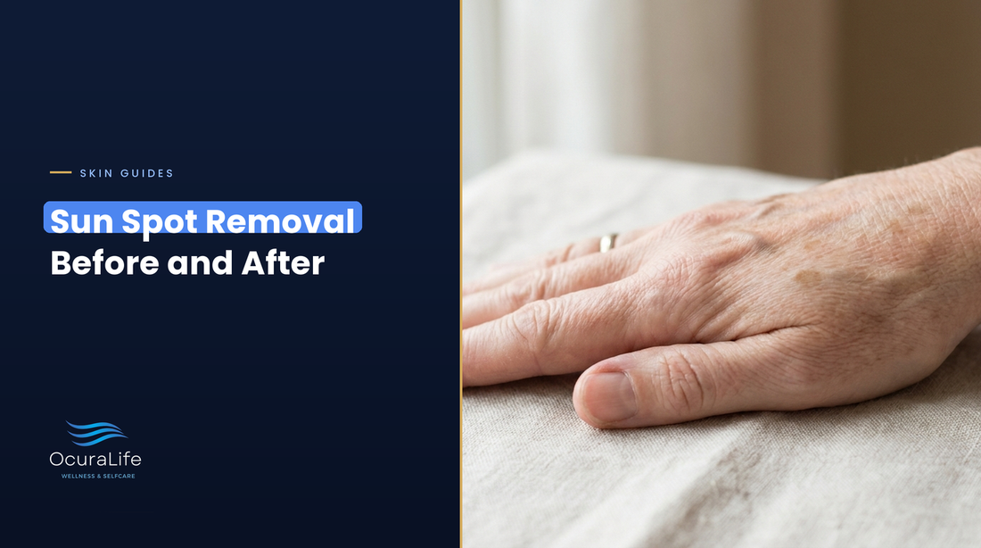 Flat light-brown sun spots on the back of a hand, sun spot removal before and after