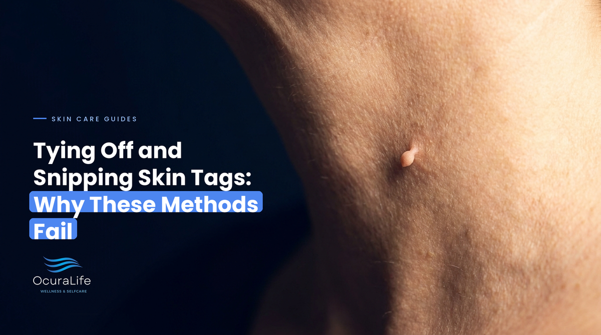 Tying Off and Snipping Skin Tags: Why These Methods Fail