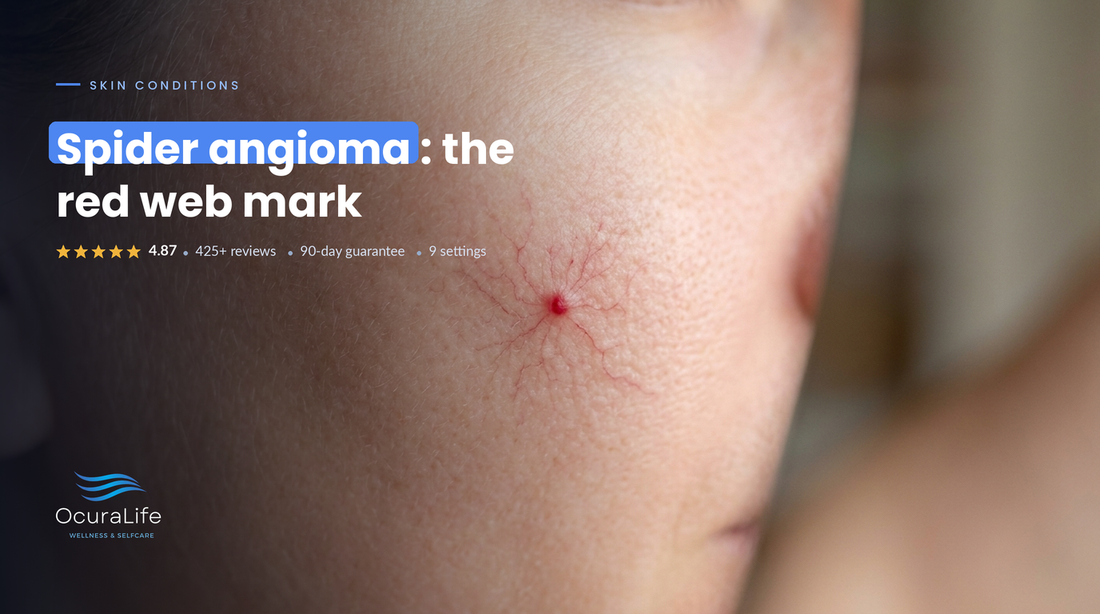 Spider Angioma: The Red Spider-Web Mark and How to Remove It