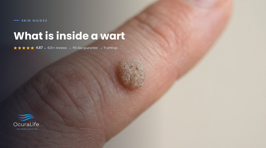 Warts: The Complete Guide to Types, Causes, and Treatment